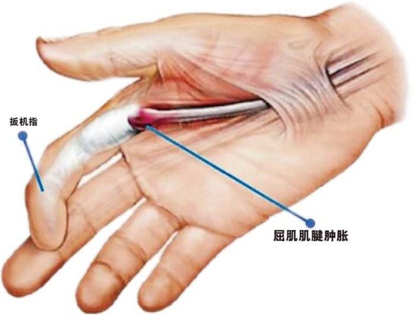 ●重度使用手机等3C产品，小心罹患扳机指。