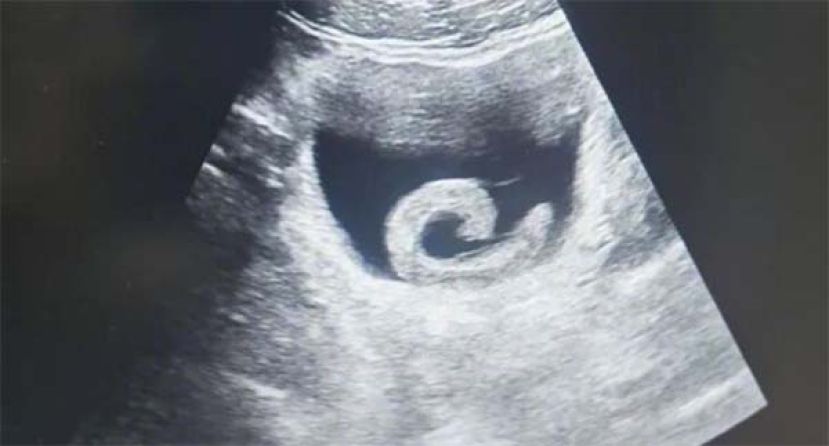 超声波检查下，水蛭被发现在病人膀胱内寄居。